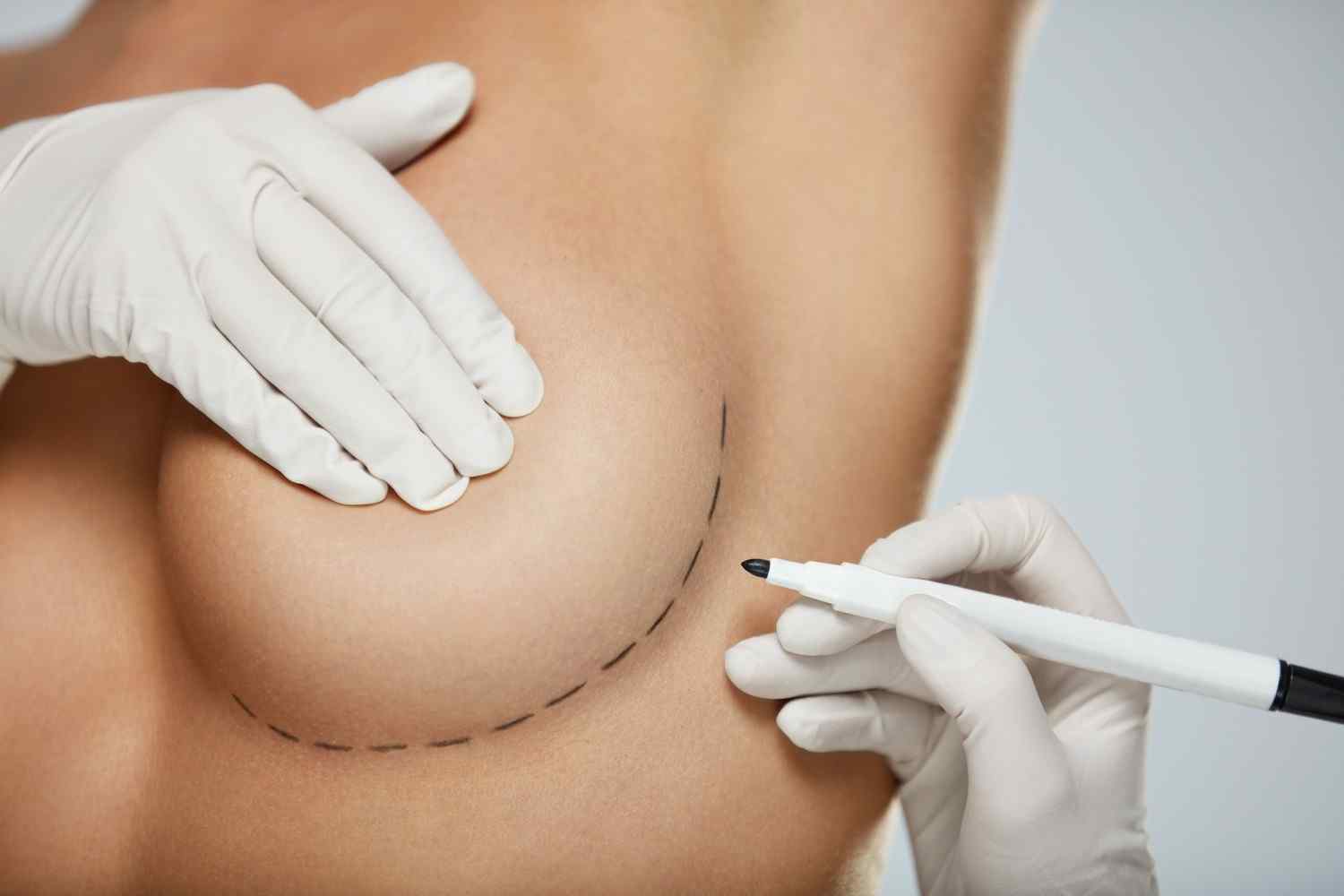 Breast augmentation Op. Dr. Belma ahin